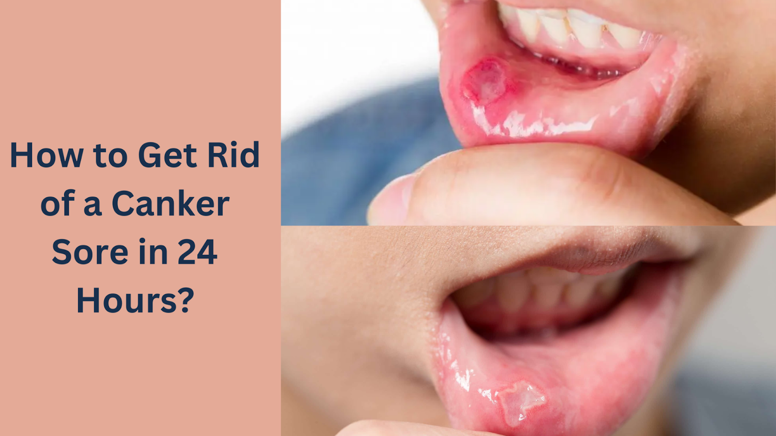 how to get rid of a canker sore in 24 hours